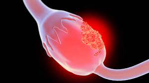 Ovarian Cancer