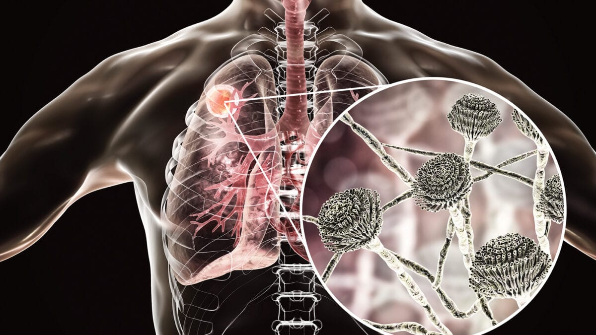 After black fungus, Aspergillus fungus reported in Covid19 patients in