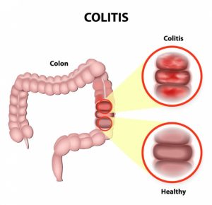 ulcerative coliltis 35629390 M