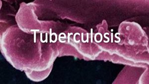 tuberculosis