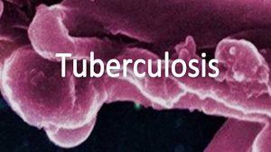 tuberculosis