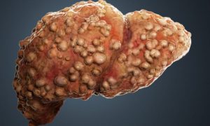 liver fibrosis alentis switzerland cirrhosis cancer 1200x720 1