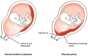 Placenta Praevia Post partum Haemorrhage