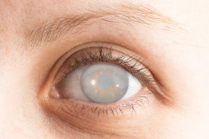 cataract in eye