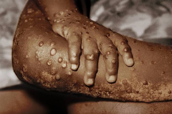 monkeypox