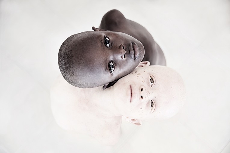 albinism