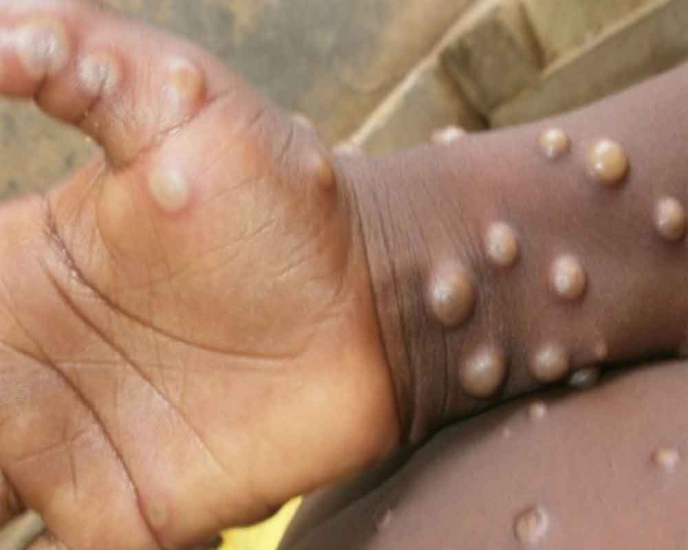 monkeypox