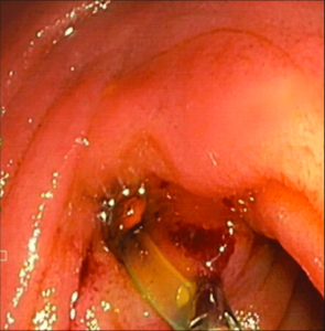 Endoscopic-removal