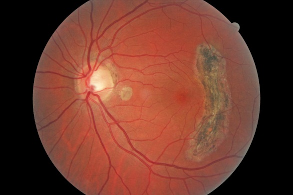 retinal scarring