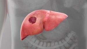 Liver Cancer