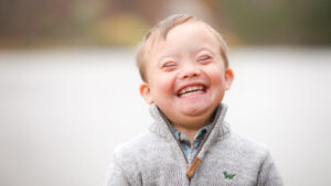 downs syndrome