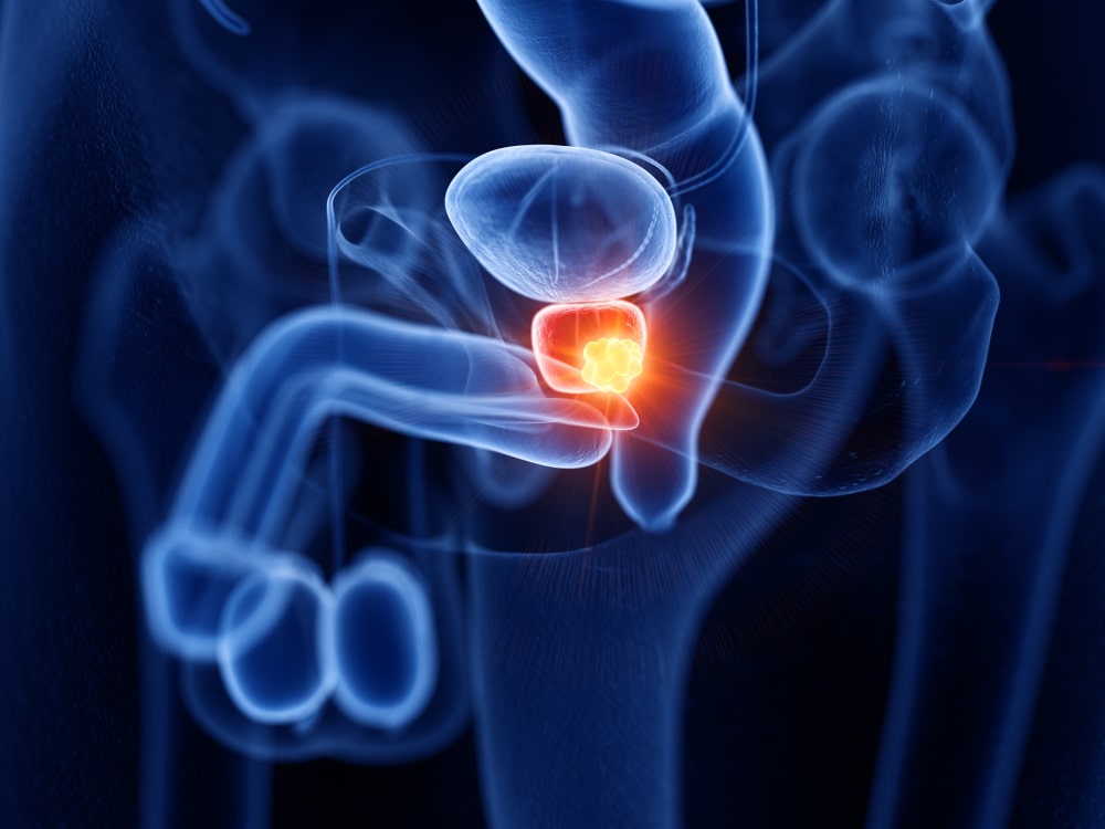 prostate cancer