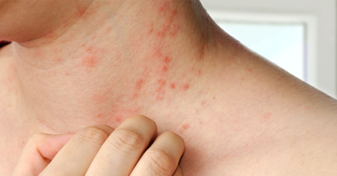 Atopic Dermatitis New Therapy Yields Encouraging Results Medically