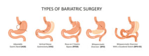 2 bariatric surgery