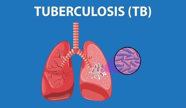 Combatting Pulmonary Tuberculosis: Recognizing Symptoms, Risks, Effective Treatments, and Crucial Preventive Measures