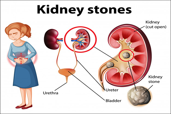 Prevent Kidney Stones: Simple Tips and Essential Information – Watch Video Now!