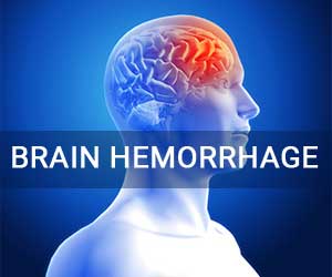 Watch Video: Prevent Brain Hemorrhage This Summer – Learn the Risks, Symptoms, and Prevention Tips