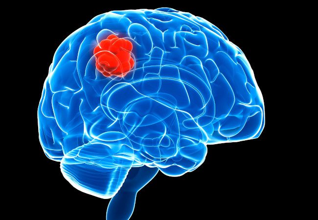 Watch Video: Morning Headaches Could Signal a Brain Tumor - Know When to Seek Help