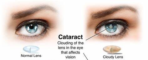 Watch Video: Timing is Everything - Discover the Best Season for Cataract Surgery!