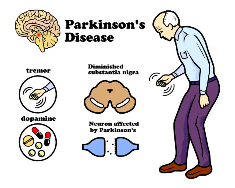 Decoding Parkinson's: Recognizing Early Signs and Empowering Action