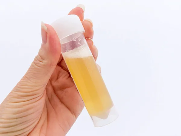 Watch the Video to Learn About Foamy Urine: A Sign of Kidney Problems?