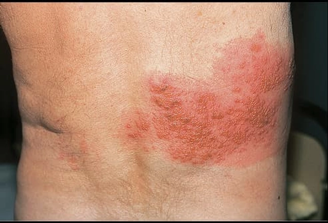 Decoding Varicella-Zoster Virus: Symptoms, Prevention, and Vital Insights for Health Protection!