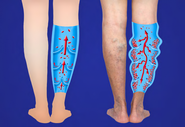 Unlocking the Secrets of Varicose Veins: Doctor Reveals Habits That Can Aggravate the Condition