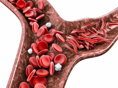 Sickle Cell Disease: Fighting the Rigid Threat Within - Watch Video to Uncover Hope and Progress!