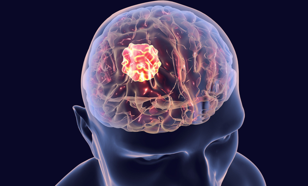 40,000 New Brain Tumor Cases Annually in India: Discover Why Early Detection is a Game-Changer