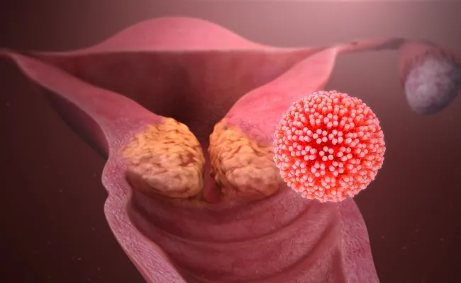 Cervical Cancer: Don't Be a Statistic! Watch Video to Take Control of Your Health and Fight Back!
