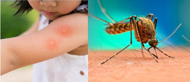 Dengue Fever's Hidden Danger: Expert Explains Neurological Complications