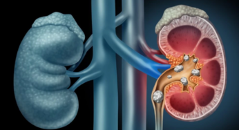 Prevent Kidney Stones Naturally: Watch Our Video for Essential Tips and Insights