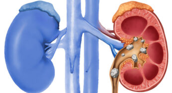 Watch Video: Effective Measures to Prevent and Treat Kidney Stones Naturally