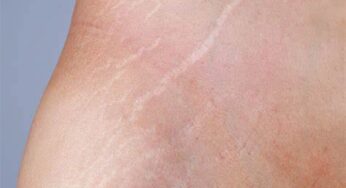 Watch Video: Discover Effective Ways to Prevent and Treat Stretch Marks for Beautiful Skin