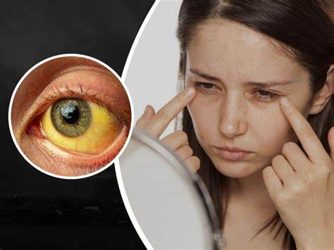 Unlock the Mystery of Jaundice: Watch Our Informative Video on Causes, Symptoms, and Essential Tips!