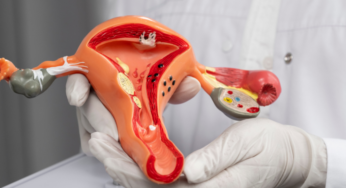 ICMR’s GROUNDBREAKING STUDY EVALUATES METFORMIN AND INOSITOL FOR PCOS