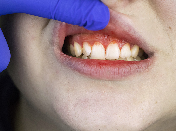 Periodontal Diseases: Understand How Sugar Impacts Your Gum Health