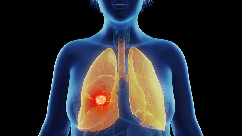 Lung Cancer Cases Rising in Non-Smokers: Why Women Are at a Growing Risk
