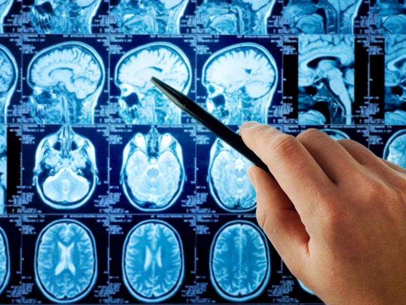 World Stroke Day: Your Essential Guide to Stroke Types Causes, Warning Signs, and Treatment Options
