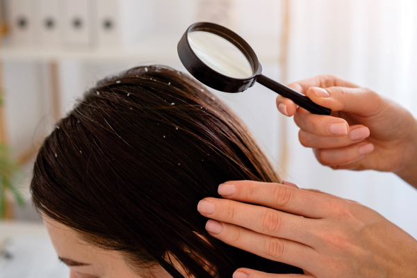 "Video: Say Goodbye to Winter Dandruff – Effective Tips and Remedies for a Healthy, Flake-Free Scalp!"