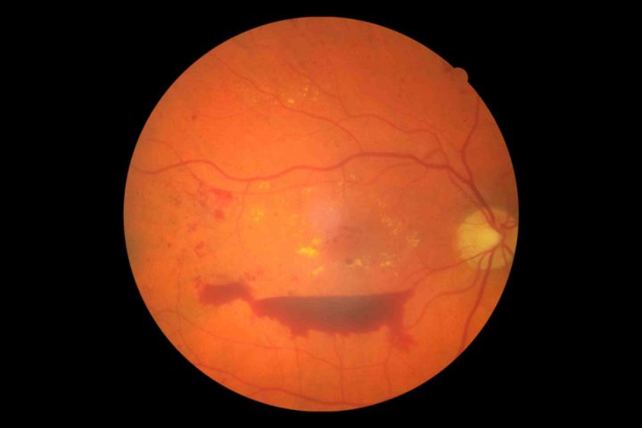 "Protect Your Vision: Essential Tips to Prevent Diabetic Retinopathy and Safeguard Your Eyesight!"