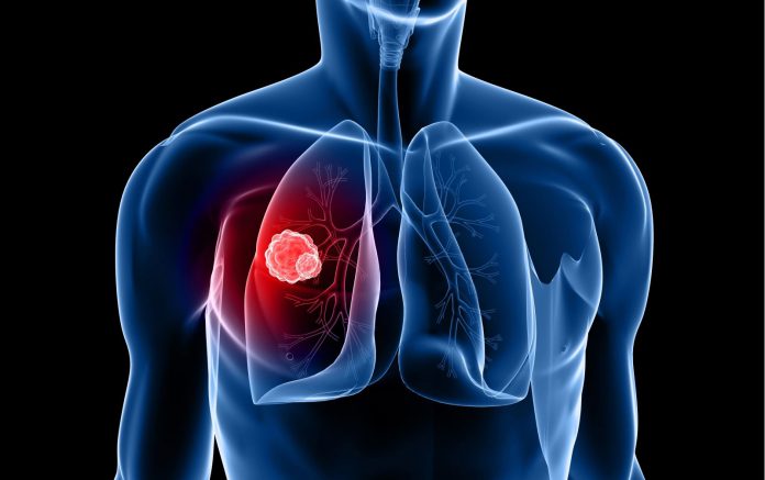 "Lung Cancer Risks: Watch This Video to Learn How Pollution and Lifestyle Choices Harm Your Lungs"