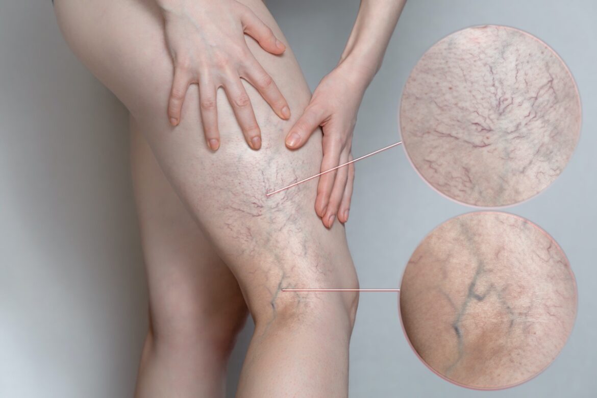 What Are Varicose Veins and How To Effectively Treat Them?