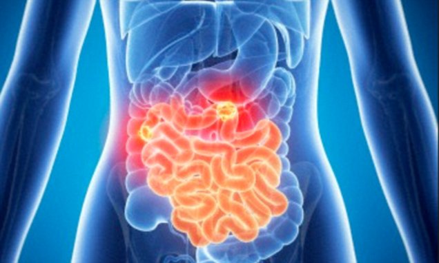 "Rising Bowel Cancer Rates Among Younger People: A Growing Public Health Crisis"