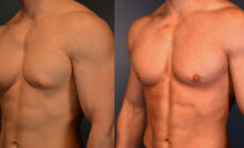 Gynecomastia Myths vs. Facts: Expert Busts Misconceptions & Shares the Right Treatment Path
