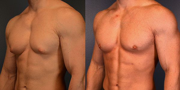 Gynecomastia Myths vs. Facts: Expert Busts Misconceptions & Shares the Right Treatment Path
