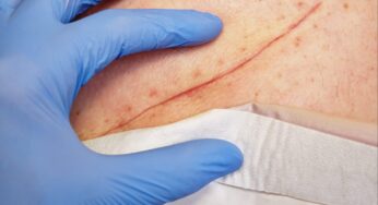 Battle Surgical Site Infections: Causes, Symptoms & Prevention Unveiled!
