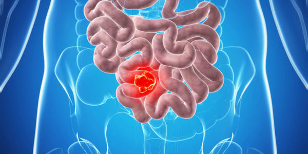 Breakthrough Blood Test Detects Bowel Cancer with 90% Accuracy
