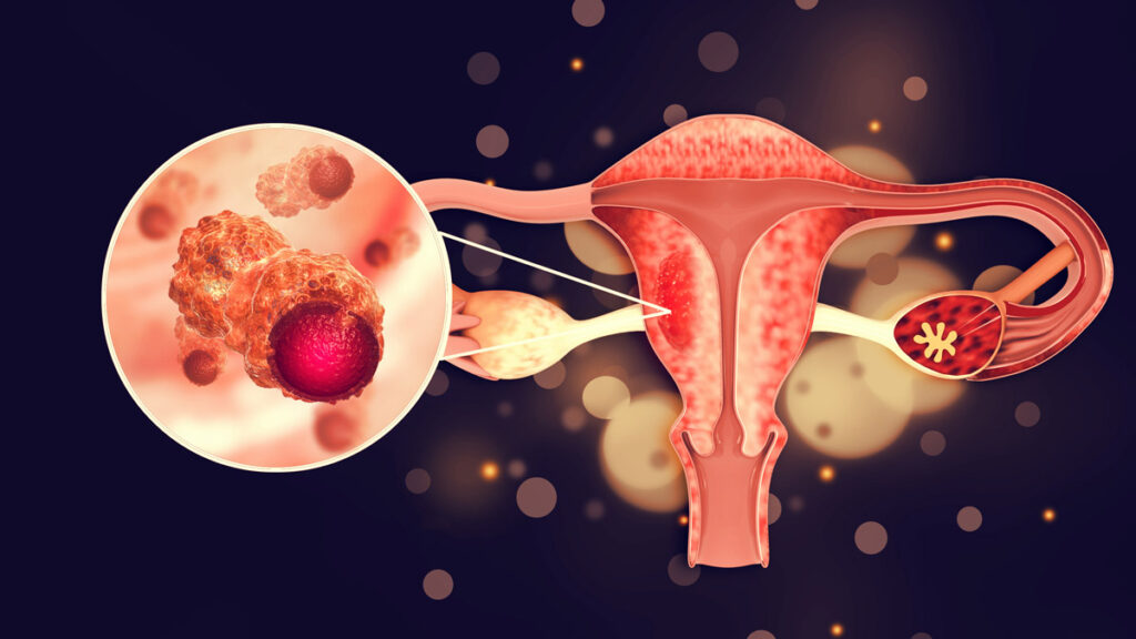 Endometriosis on the Rise: Are You at Risk