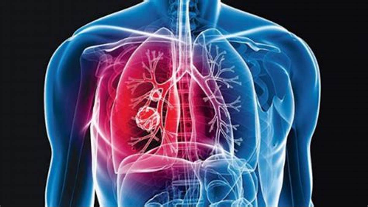 Lung Cancer on the Rise in Non-Smoker Women: The Hidden Dangers